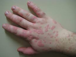Egyszerűen megoldható az allergiás kiütés kezelése házilag
